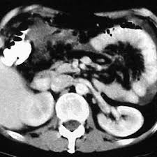 Multicystic peritoneal mesothelioma (mcpm) is a particularly rare and benign neoplasm that arises from the peritoneum in reproductive aged females. Cystic Peritoneal Mesothelioma Eurorad