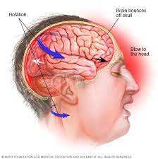 Concussion Testing - Mayo Clinic