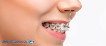 Check spelling or type a new query. Forsus Fatigue Resistant Device For Correction Of Overbites