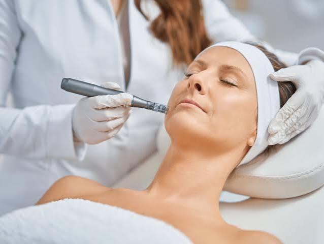 Microneedling treatment at Profrea