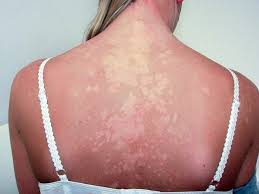 We did not find results for: Pityriasis Versicolor Hautarztpraxis Geesthacht