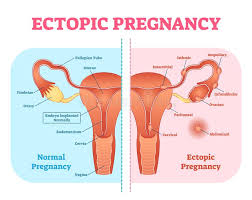 Most common malignancy of the female reproductive tract. Ectopic Pregnancy Or Tubal Pregnancy Medical Diagram With Female Reproductive System And Various Embryo Attachment Locations Stock Vector Illustration Of Organ Maternal 111598857