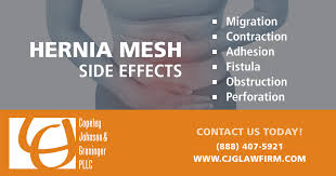 Lawsuits filed over withdrawn hernia mesh. What You Need To Know About Hernia Mesh Johnson Groninger Pllc