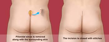 The condition of cyst on the tailbone is called a pilonidal cyst. Pilonidal Cyst Austin Tx Pilonidal Sinus Austin Tx Texas
