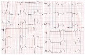 La miocarditis es la inflamación del músculo cardíaco (miocardio). Acute Myocarditis Mimicking St Elevation Myocardial Infarction A Case Report And Review Of The Literature