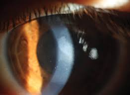 Hsv stromal keratitis without ulceration source: Watch Out For Hsv Endotheliitis