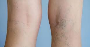 Les Varices En 10 Questions Doctissimo