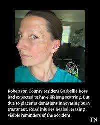 When a fire charred Gabrielle Ross' face, hand and arm, doctors in Middle  Tennessee treated her wounds using something with special healing powers −  the placenta donated by a mother after the