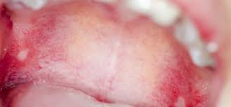 Image result for Canker sores symptoms roof of the mouth