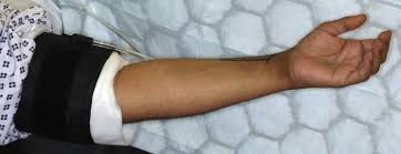 Therefore, carefully time and monitor tourniquet use, explains medialab. Cureus Minimising Tourniquet Time And Post Operative Pain During Carpal Tunnel Decompression
