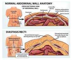 To diagnose diastasis recti a practitioner will feel for a gap between muscles of more than 2cm, further imaging via ultrasound if it gets detected early enough there are definitely ways you can prevent it from getting worse and help restore tension across the separation. How To Prevent Diastsis Recti During Pregnancy Beyondfit Mom