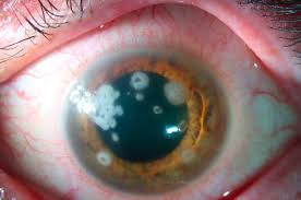 Image result for Ciliary Flush