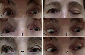 Image result for Pupillary Paralysis