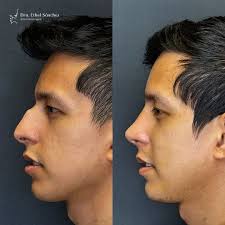 🙋🏻‍♀️ Cambios increíbles con una rinoplastia. Atrévete a conocer una  nueva versión de ti y realza tu belleza con una transformación que te hará  sentir mucho más seguro y feliz ✨ 👩🏻‍⚕️