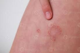 Image result for dermatitis contacta children