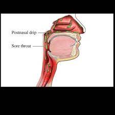 Pin By Genna Mcneill On Health Remedies Natural Cures Post Nasal Drip Remedy