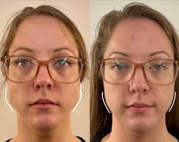 Boost Your Glow with Sculptra: Expert Tips and Tricks