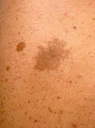 Mar 20, 2018 · a painful lump under the collarbone. Cyst On Shoulder Skin Cysts Lumps Bumps Everyday Health