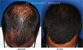 Before And After Gallery Oc Hair Restoration Center Irvine Hair Loss Surgeon Orange County Ca Help Hair Loss Hair Loss Remedies Hair Loss