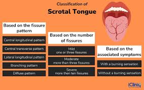 Image result for Fissured tongue