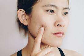 Acne Scars: Your Treatment Options - American Board of Facial Cosmetic  Surgery