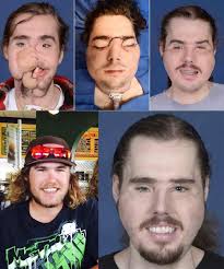 Man undergoes face transplant after decade of struggles