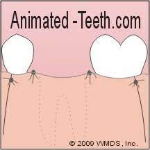 Dental Stitches Dissolving Vs Regular As Used With Tooth Extractions Wisdom Teeth