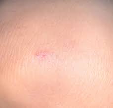 Image result for Bat Bite