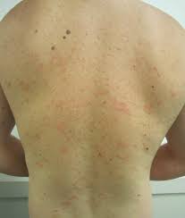 Some people develop a few large patches on as a large patch tends to be the first sign of pityriasis rosea, this patch is often given one of the. Pityriasis Rosea Wikipedia