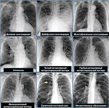 Zabolevaniya Legkih Legochnaya Konsolidaciya Infiltraciya Statya Radiology Assistant 24radiology Ru