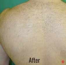 You can also purchase spa gift cards online instantly. Patient 4337 Laser Hair Removal Before And After Photos Brea Plastic Surgery Gallery Costa Mesa Skin Perfect Medical