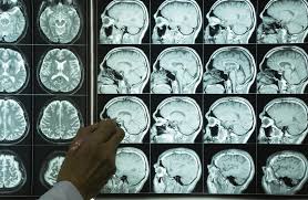 Loss of substantia nigra hyperintensity on 7 tesla mri of parkinson's disease, multiple system atrophy, and progressive supranuclear palsy. Dementia Brain Mapping Method May Predict Progression