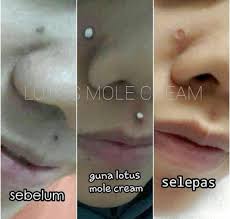Itupun, sekiranya tidak mendatangkan mudarat kepada muka. Betulkah Petua Buang Tahi Lalat Ini Berkesan Tanpa Pembedahan Syafierayamin Com Beauty Blogger Malaysia