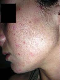 Granos Infectados Que Supuran Y Empeoran Con El Sol Dermatologo Net