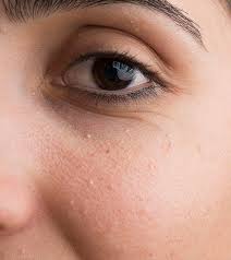 How To Get Rid Of Milia White Pimples On Face Skin Bumps Pimples On Face