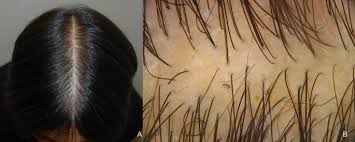 Fergie's new look marks the culmination of the matrix socolor cult social media contest. Female Androgenetic Alopecia An Update On Diagnosis And Management Springerlink