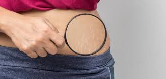 يمكن لأي شخص كان مصابًا بجدري الماء أن يُصاب بالهربس النطاقي. Ø¸Ù‡ÙˆØ± Ø®Ø·ÙˆØ· Ø­Ù…Ø±Ø§Ø¡ Ø¹Ù„Ù‰ Ø§Ù„Ø¬Ù„Ø¯ Ù…ÙˆØ¶ÙˆØ¹