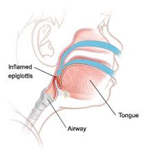 Image result for Epiglottitis