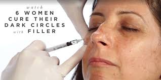 Dark circles can be caused by not having enough vitamin k due to aging process. Filler For Dark Under Eye Circles Get Rid Of Under Eye Circles With Injections