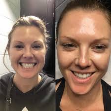 Pin By Jessica Silva On Non Surgical Botox Jawline Facial Plastic Surgery