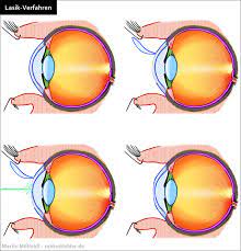 Bevor wir beleuchten, wann es sinnvoll sein kann, sich die augen lasern zu lassen, zeigen wir auf, wie dieses sinnesorgan eigentlich funktioniert. Augenlasern Lasik Verfahren Kosten Risiken