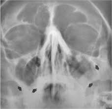 Image result for Sinus X Ray