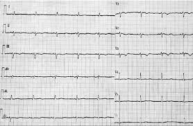 Image result for Epsilon Wave