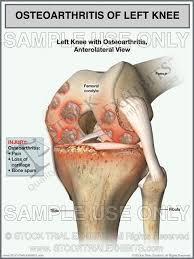 Medical Exhibit Of Osteoarthritis Of The Left Knee Osteoarthritis Bone Spurs Knee Osteoarthritis