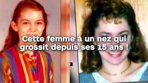 Cette femme à un nez qui grossit depuis ses 15 ans !