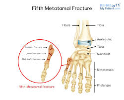 Image result for Metatarsal