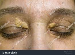 Image result for xanthelasma of eyelid