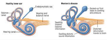 Meniere S Disease Hearing Health Associates Official Website