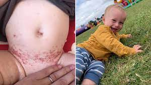 Depending on the group of cells affected, a skin cancer can be called basal cell carcinoma. Baby S Patch Of Eczema Turns Out To Be Rare Childhood Cancer Metro News
