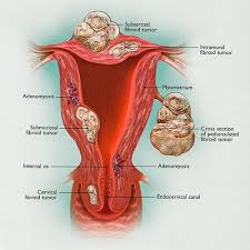 The majority of women are diagnosed when the cancer is in an advanced stage. Infertility Symptoms Causes And Treatments Cigc